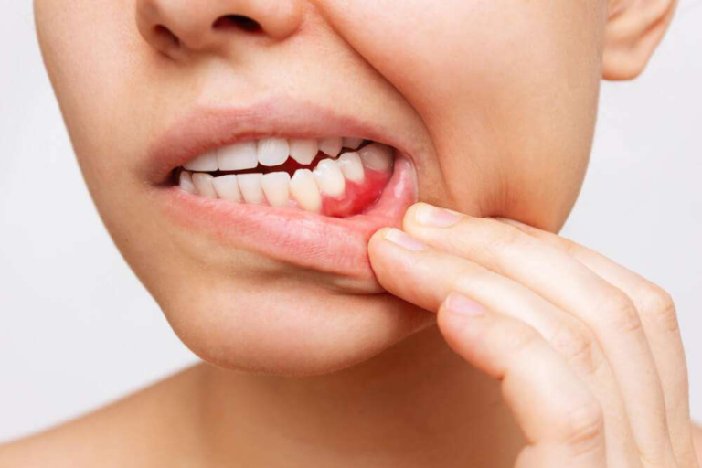 Why Bleeding Gums Should Never Be Ignored Even If They Don’t Hurt