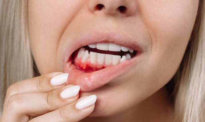 Why Bleeding Gums Should Never Be Ignored Even If They Don’t Hurt